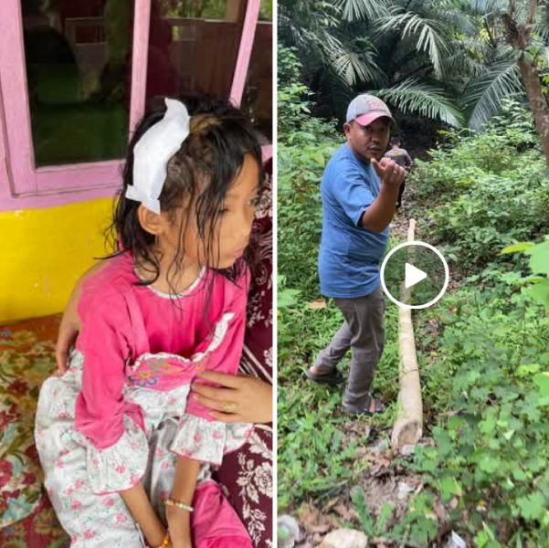 Salah satu anak yang menjadi korban penyerangan monyet liar di Kelurahan Bontokamase Kecamatan Herlang, Bulukumba.