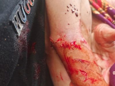 Korban serangan monyet liar di Kecamatan Herlang Bulukumba dirawat di Puskesmas