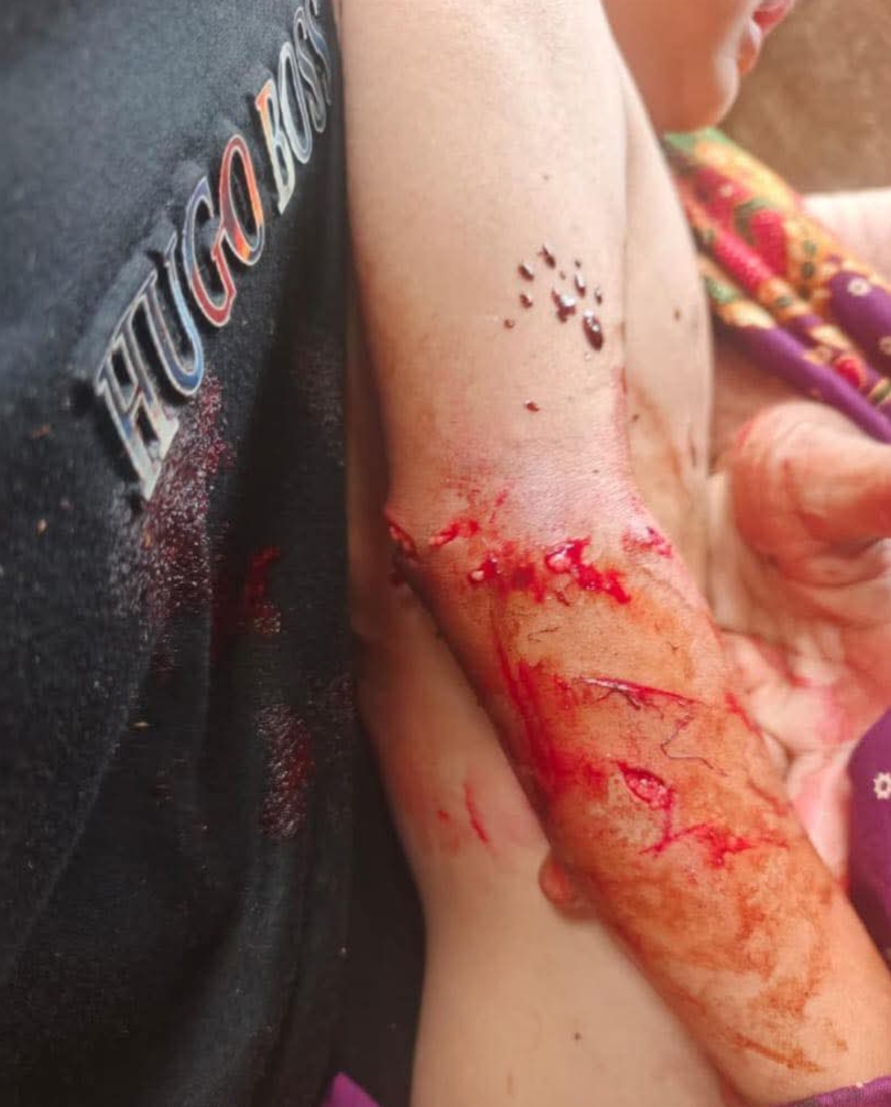 Korban serangan monyet liar di Kecamatan Herlang Bulukumba dirawat di Puskesmas