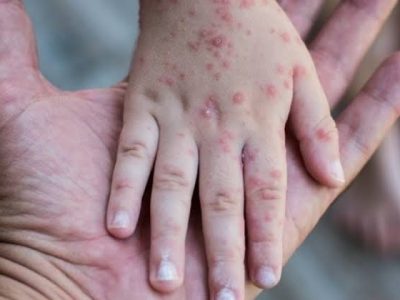 Program imunisasi kejar campak digelar Pemerintah Kabupaten Bulukumba untuk meningkatkan cakupan imunisasi dan mencegah penyebaran kasus campak.