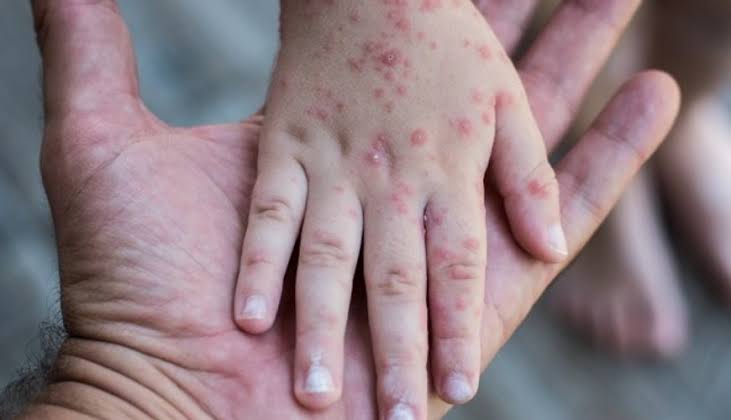 Program imunisasi kejar campak digelar Pemerintah Kabupaten Bulukumba untuk meningkatkan cakupan imunisasi dan mencegah penyebaran kasus campak.